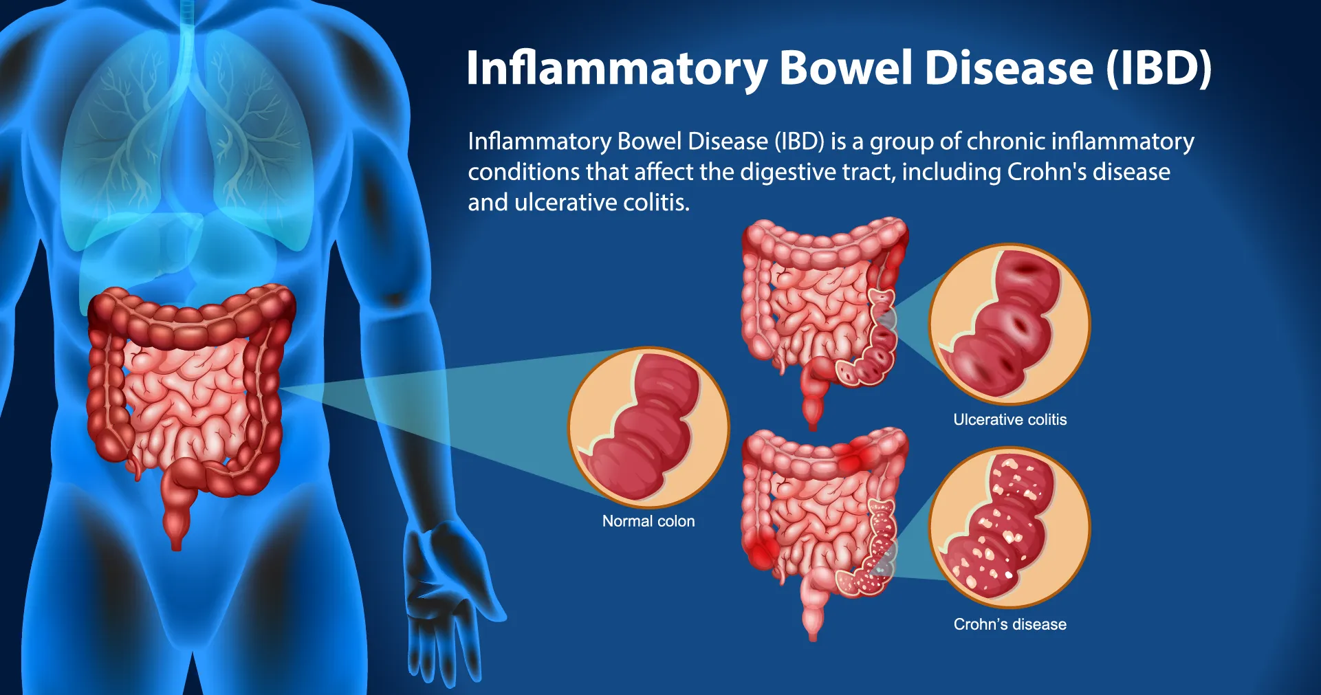 inflammatory bowel disease treatment