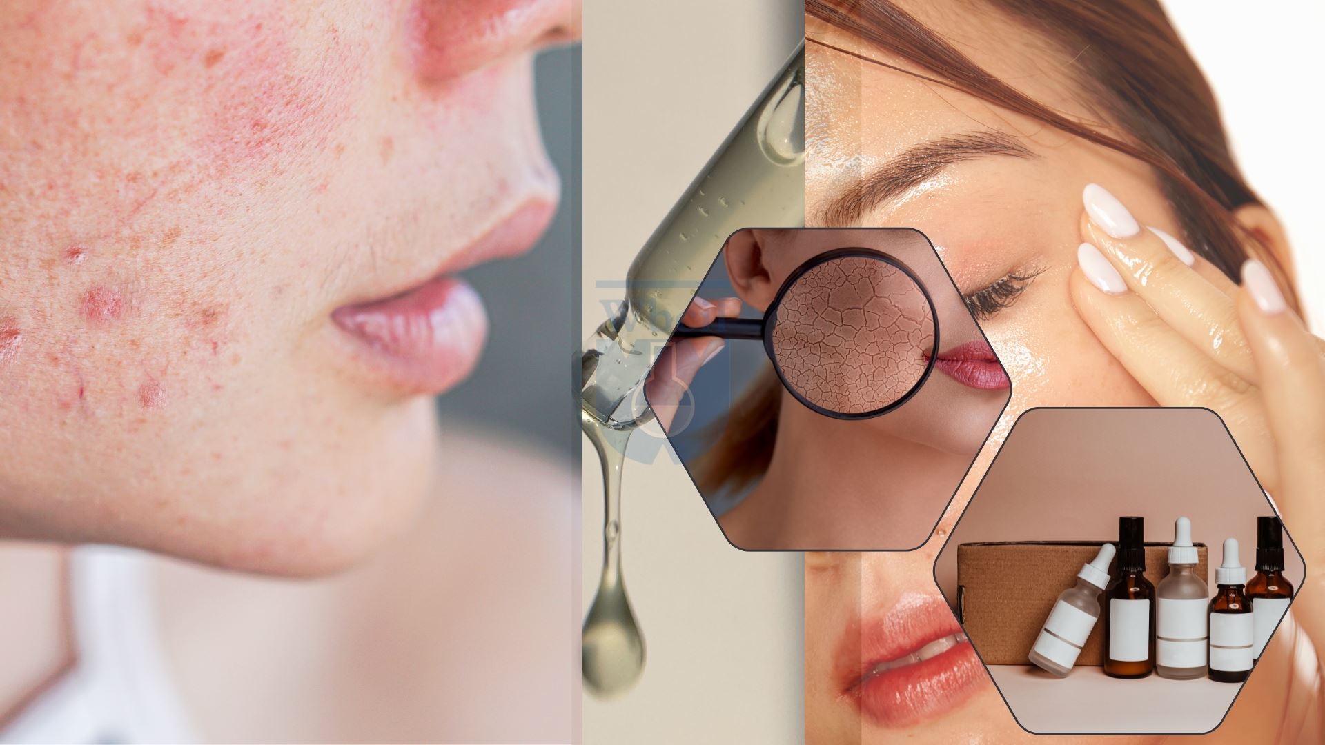 Liposomal glycolic acid and salicylic acid serum
